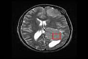 بررسی حساسیت و اختصاصیت ترکیب دو روش Magnetic Resonance Spectroscopy(MRS) و  Diffusion MRI (DWI) (با دستگاه MRI 3 تسلا) در درجه بندی تومورهای گلیال در مقایسه با درجه بندی پاتولوژیک تومور، پس از جراحی .